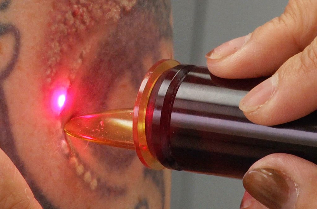 Laser_Tattoo_Removal_Alice_Pien_MD_AMAskincare
