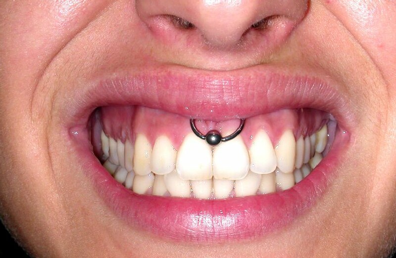 Silver-Bead-Ring-Gum-Piercing