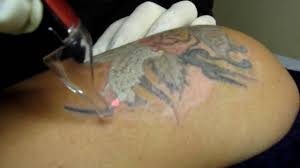 Tatuaggi rimossi