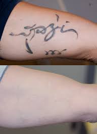 tatuaggio rimosso