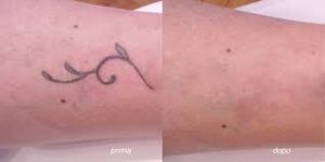 tatuaggi rimossi