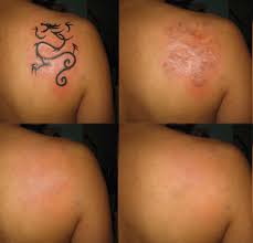 tatuaggi rimossi