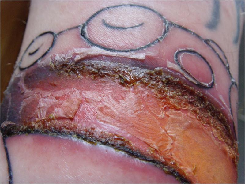 infected-tattoo-3