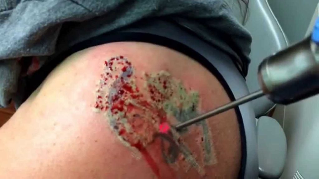 rimuovere-tatuaggio-ferita