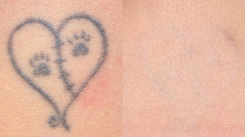 rimuovere-tatuaggio-intermedio