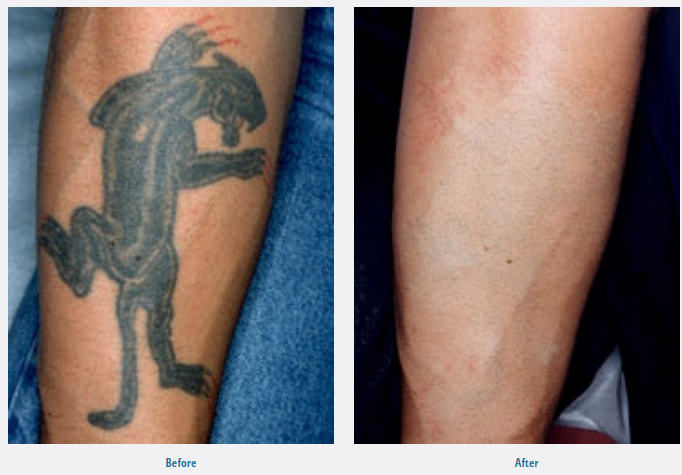 tattoo-removal