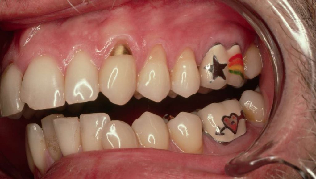 tatuaggio-sui-denti