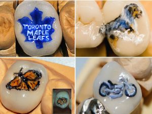 tatuaggio-sui-denti-capsule