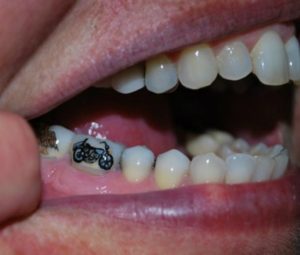 tatuaggio-sui-denti-moto
