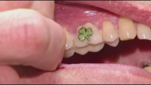 tatuaggio-sui-denti-quadrifoglio