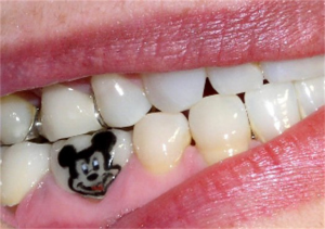 tatuaggio-sui-denti-topolino