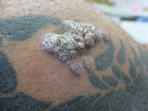 reazioni allergiche