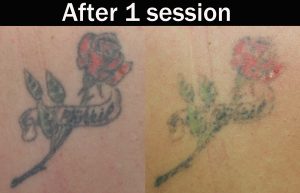 Laser-tattoo-removal