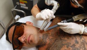 Rimozione-tatuaggi-con-il-laser
