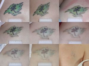 Tattoo Remover