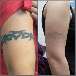 rimozione tattoo