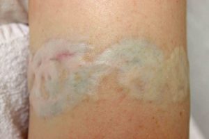 remove tattoo