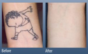 removes tattoo